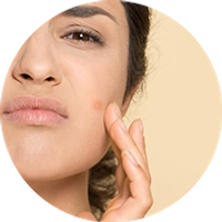 Acne Prone Skin