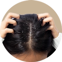 Dandruff